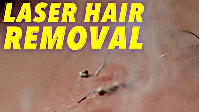 Science of Laser Hair Removal in SLOW MOTION thumbnail